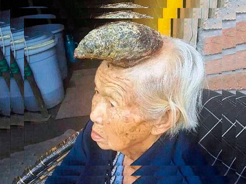 ¿Mujer unicornio? China de 87 años impresiona con un gran cuerno en la frente
