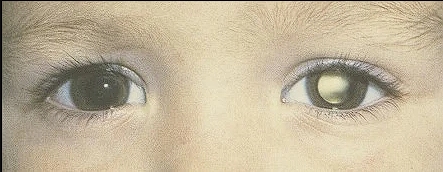 Foto cercana de los ojos de un niño, en uno de ellos se puede ver una placa blanca o reflejo en el interior del iris llamado leurocoria.